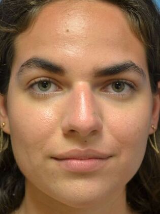 Rhinoplasty Case 1730- Defiance, OH - Before