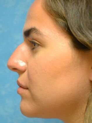 Rhinoplasty: Case 1730- Defiance, OH - Before