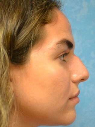 Rhinoplasty: Case 1730- Defiance, OH - Before
