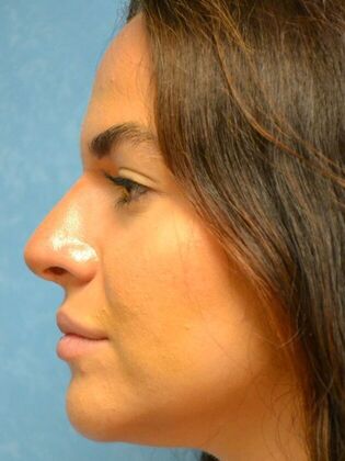 Rhinoplasty: Case 1730- Defiance, OH - After
