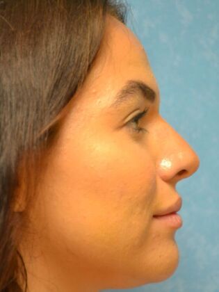 Rhinoplasty: Case 1730- Defiance, OH - After