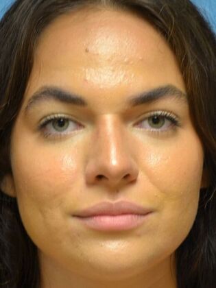 Rhinoplasty Case 1730- Defiance, OH - After