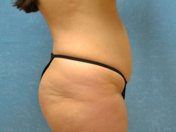 Tummy Tuck: Case 1812- Perrysburg, OH - Before