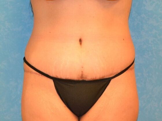 Tummy Tuck Case 1812- Perrysburg, OH - After