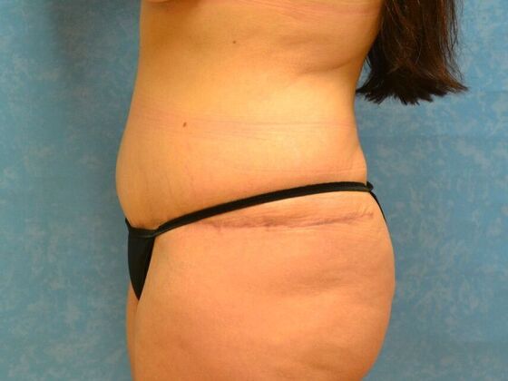 Tummy Tuck: Case 1812- Perrysburg, OH - After
