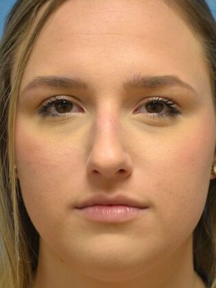 Rhinoplasty Case 1731- Sylvania, OH - Before