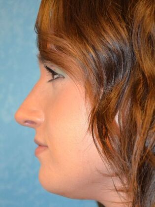 Rhinoplasty: Case 1731- Sylvania, OH - After