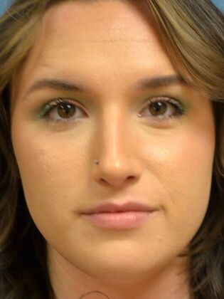 Rhinoplasty Case 1731- Sylvania, OH - After