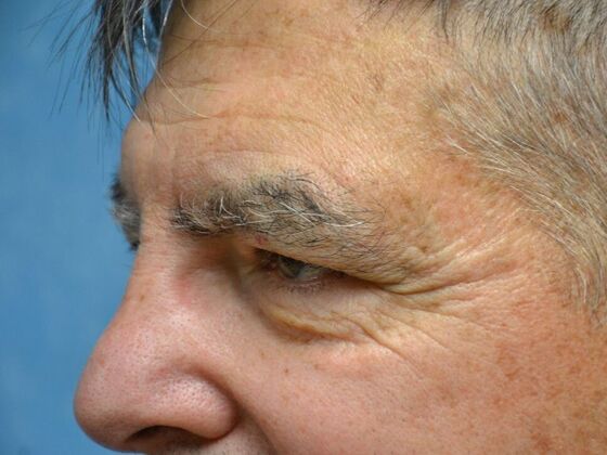 Eye Lift (Blepharoplasty): Case 1777- Perrysburg, OH - Before