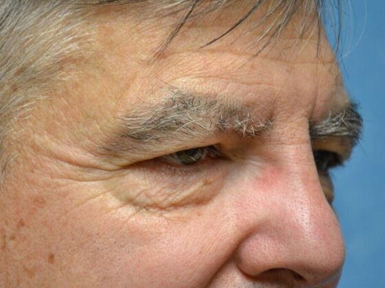 Eye Lift (Blepharoplasty): Case 1777- Perrysburg, OH - Before