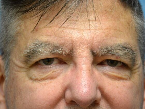 Eye Lift (Blepharoplasty) Case 1777- Perrysburg, OH - Before