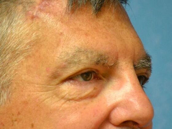 Eye Lift (Blepharoplasty): Case 1777- Perrysburg, OH - After