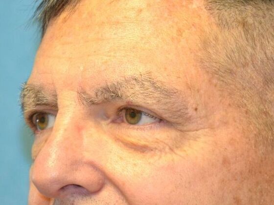 Eye Lift (Blepharoplasty): Case 1777- Perrysburg, OH - After