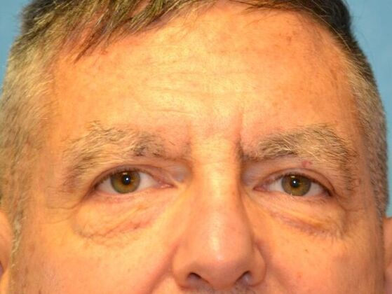 Eye Lift (Blepharoplasty) Case 1777- Perrysburg, OH - After