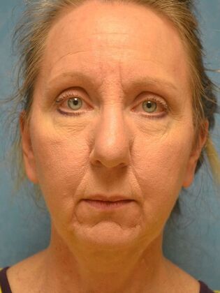 Face & Neck Lifts Case 1660- Sylvania, OH - Before