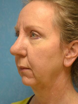 Face & Neck Lifts: Case 1660- Sylvania, OH - Before