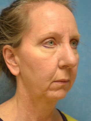 Face & Neck Lifts: Case 1660- Sylvania, OH - Before