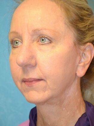 Face & Neck Lifts: Case 1660- Sylvania, OH - After