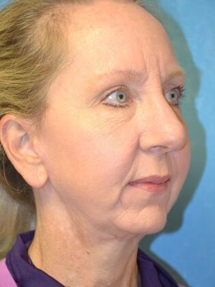 Face & Neck Lifts: Case 1660- Sylvania, OH - After