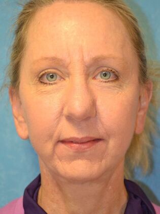 Face & Neck Lifts Case 1660- Sylvania, OH - After