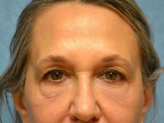 Eye Lift (Blepharoplasty) Case 1778- Perrysburg, OH - Before