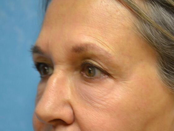 Eye Lift (Blepharoplasty): Case 1778- Perrysburg, OH - Before