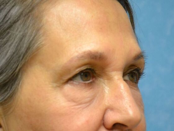 Eye Lift (Blepharoplasty): Case 1778- Perrysburg, OH - Before