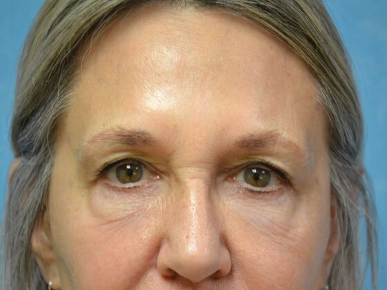 Eye Lift (Blepharoplasty) Case 1778- Perrysburg, OH - After