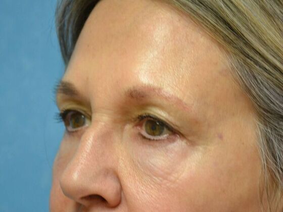 Eye Lift (Blepharoplasty): Case 1778- Perrysburg, OH - After