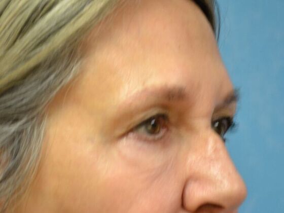 Eye Lift (Blepharoplasty): Case 1778- Perrysburg, OH - After