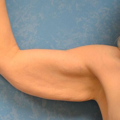 Arm Lift Case 1513- McComb, OH - Before