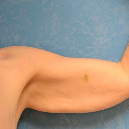 Arm Lift: Case 1513- McComb, OH - Before