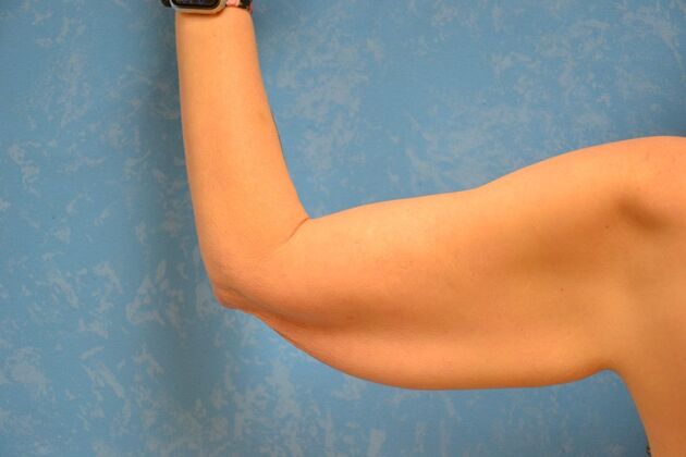 Arm Lift: Case 1513- McComb, OH - Before