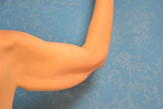 Arm Lift: Case 1513- McComb, OH - Before