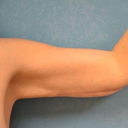 Arm Lift: Case 1513- McComb, OH - After