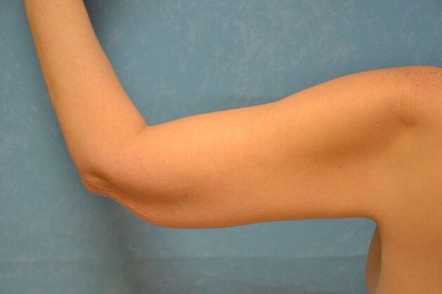 Arm Lift: Case 1513- McComb, OH - After