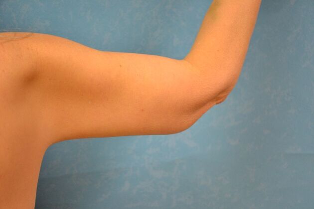 Arm Lift: Case 1513- McComb, OH - After