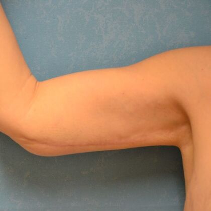 Arm Lift Case 1513- McComb, OH - After