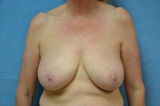 Breast Lift Case 1499- Dundee, MI - Before