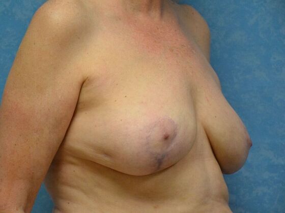 Breast Lift: Case 1499- Dundee, MI - After