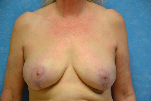 Breast Lift Case 1499- Dundee, MI - After