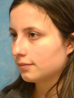 Rhinoplasty: Case 1732- Sylvania, OH - Before