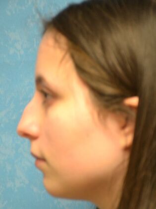 Rhinoplasty: Case 1732- Sylvania, OH - Before