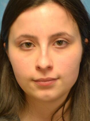 Rhinoplasty Case 1732- Sylvania, OH - Before