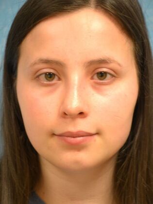 Rhinoplasty Case 1732- Sylvania, OH - After