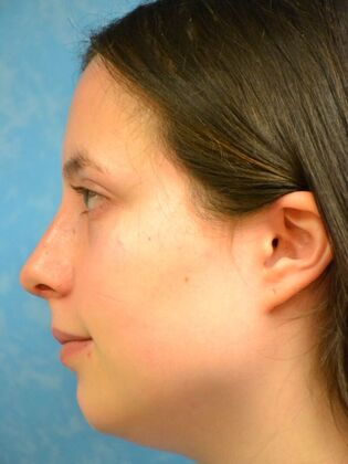 Rhinoplasty: Case 1732- Sylvania, OH - Before