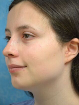 Rhinoplasty: Case 1732- Sylvania, OH - After