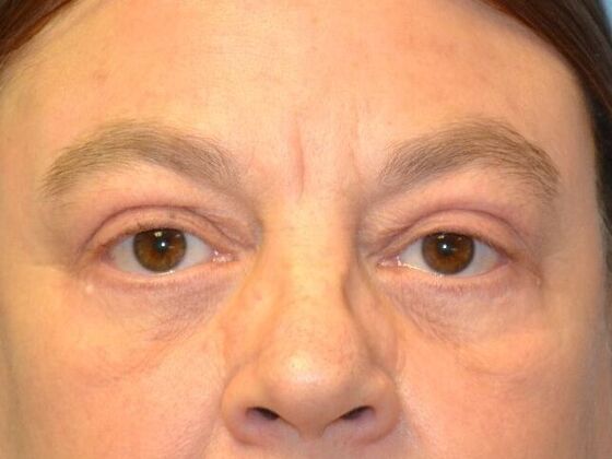 Eye Lift (Blepharoplasty) Case 1779- Toledo, OH - After