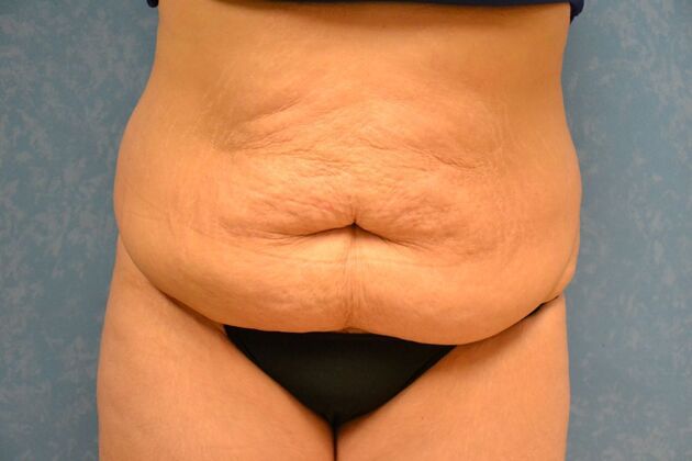 Tummy Tuck Case 1799- Toledo, OH - Before