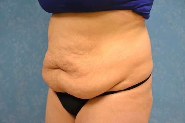 Tummy Tuck: Case 1799- Toledo, OH - Before
